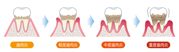 歯肉炎・歯周炎・歯槽膿漏の違い